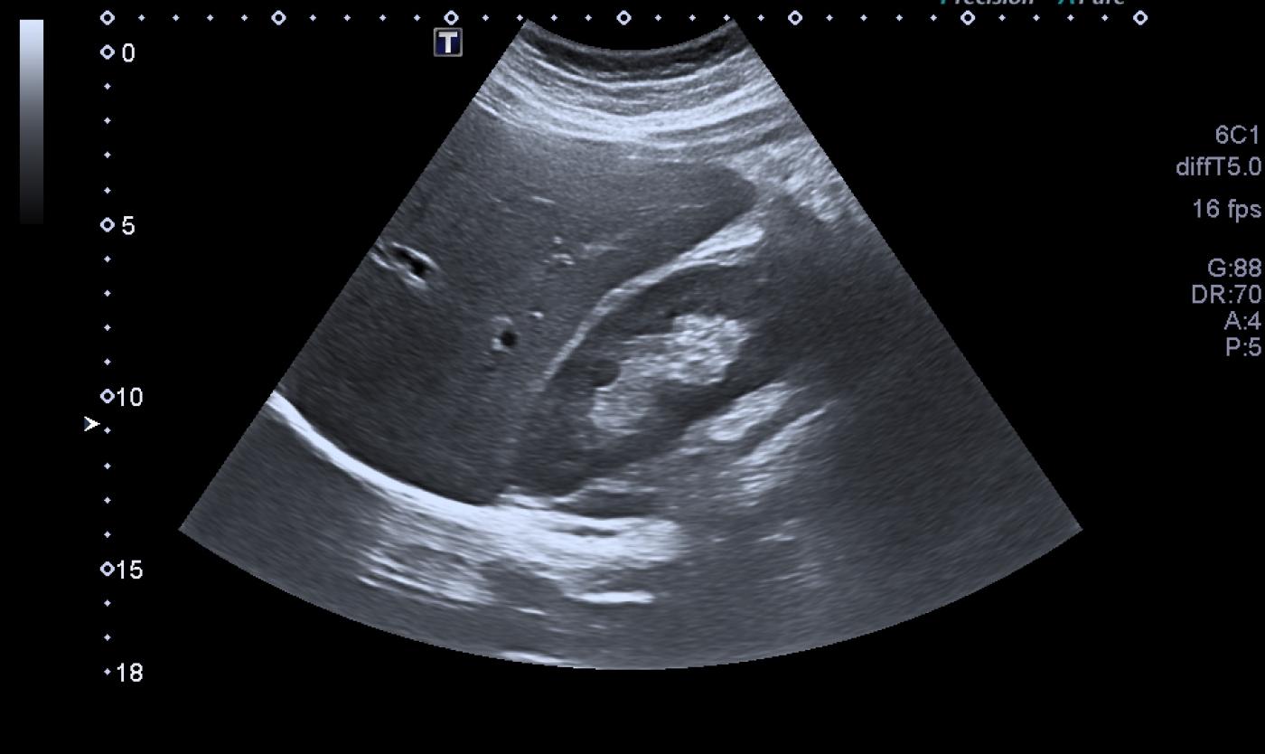 Ultrasound Ultrasound