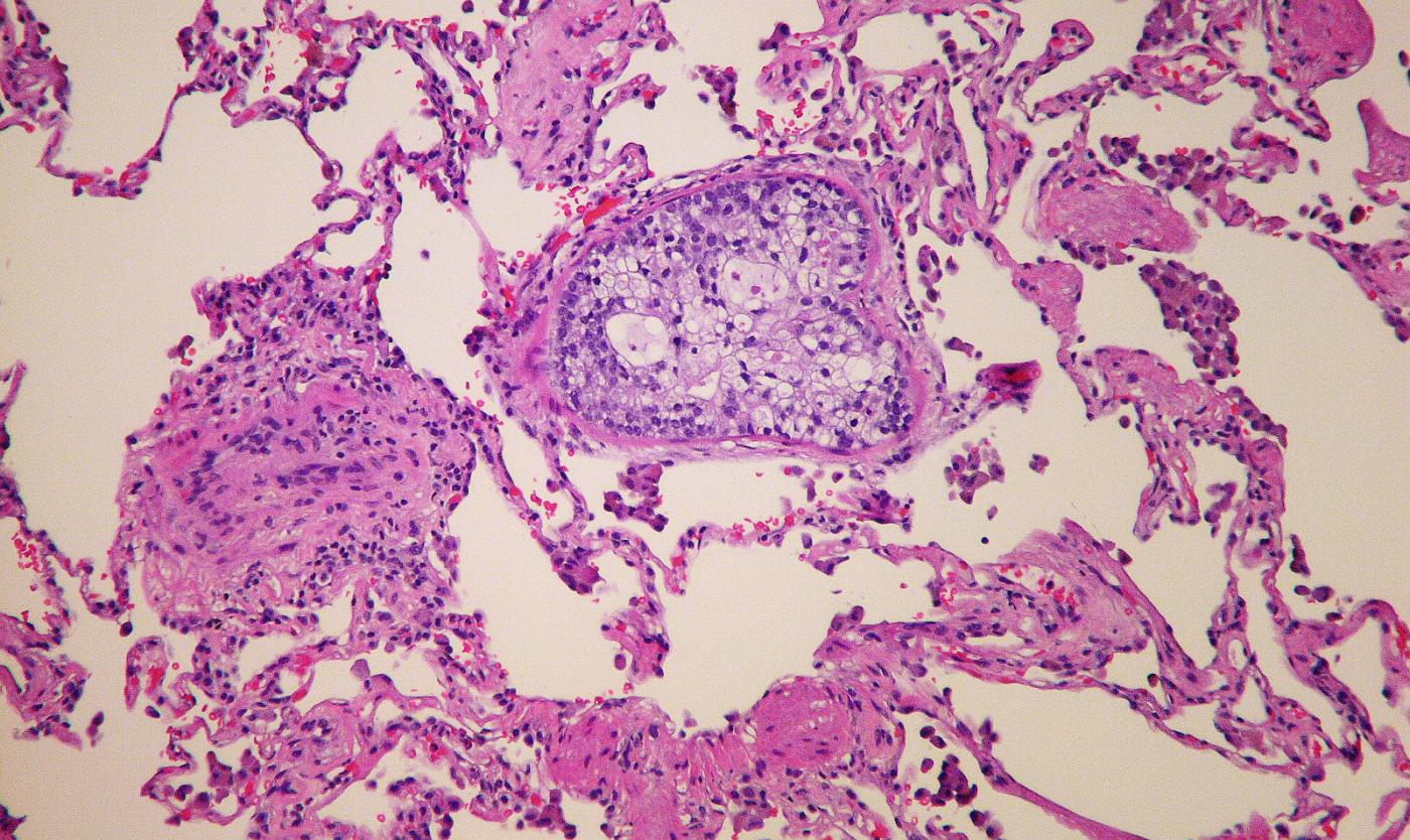 2023_KANKER_TUMOR_METASTATIC_PROSTATIC_ADENOCARCINOMA_YALE_ROSEN