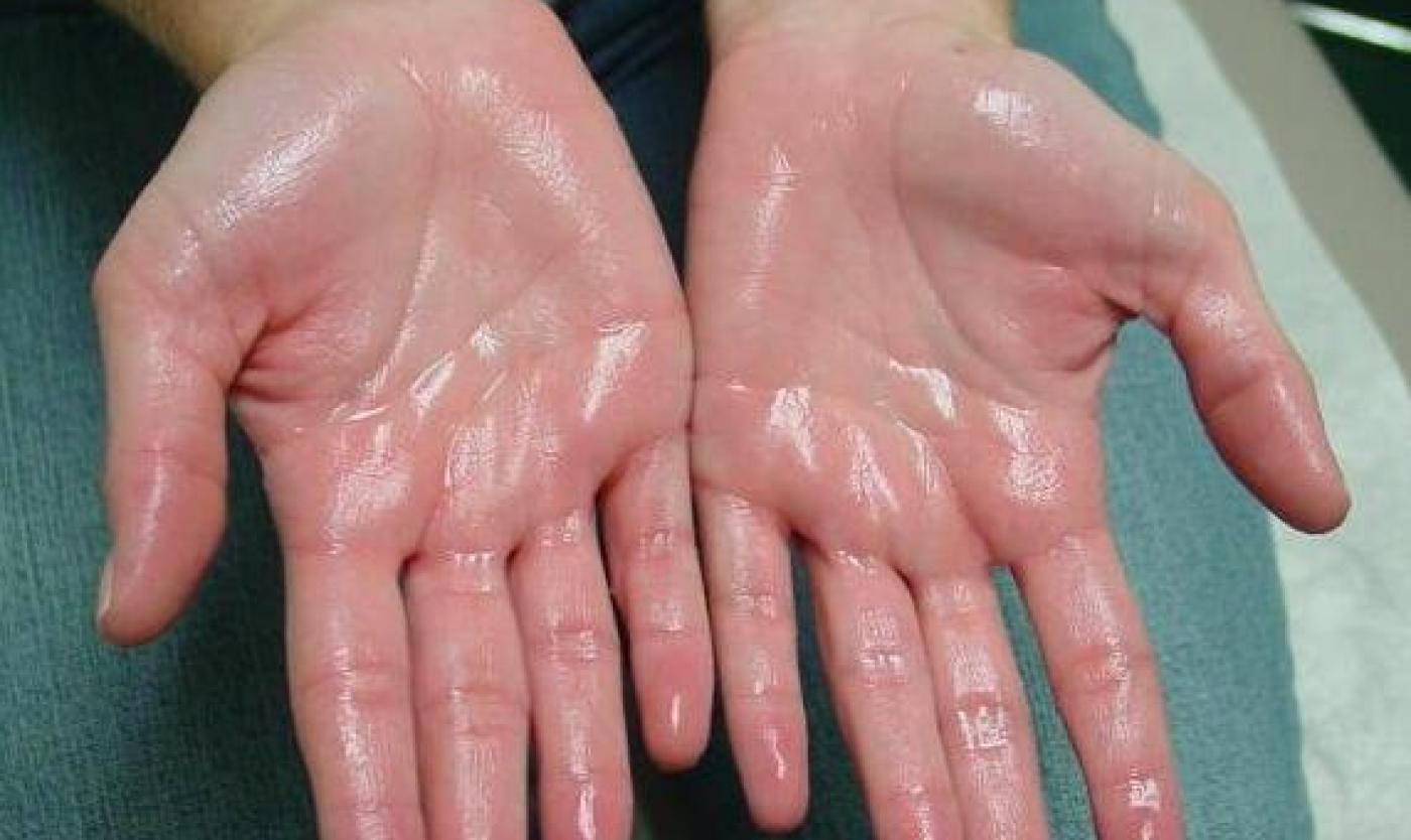 Hyperhidrosis_Treatment.jpg
