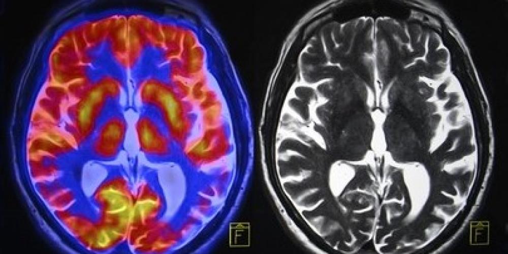 Brainscan Brainscan