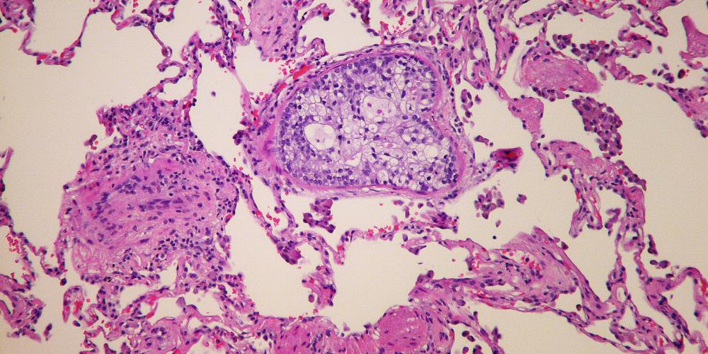 2023_KANKER_TUMOR_METASTATIC_PROSTATIC_ADENOCARCINOMA_YALE_ROSEN 2023_KANKER_TUMOR_METASTATIC_PROSTATIC_ADENOCARCINOMA_YALE_ROSEN