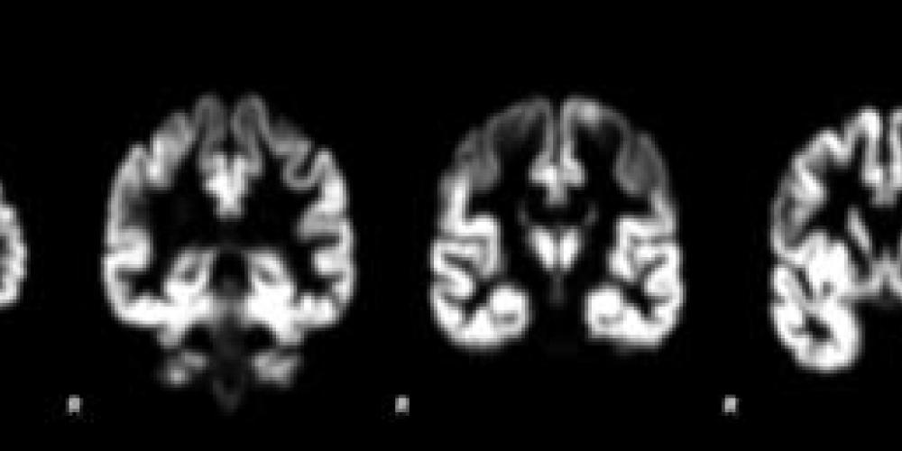 Decoding Brain Health
