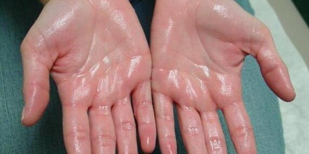 Hyperhidrosis_Treatment.jpg
